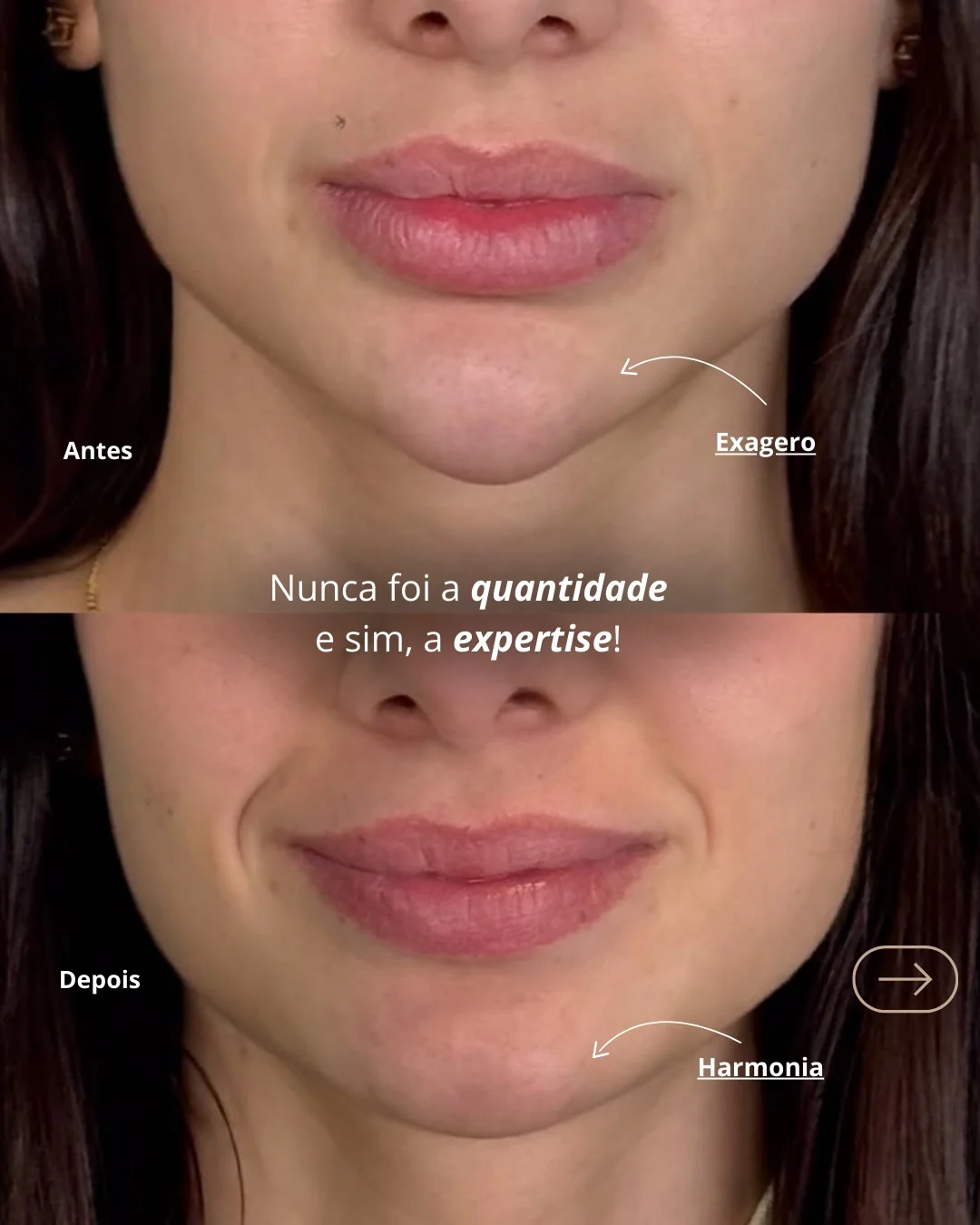 Antes e depois de harmonização labial natural