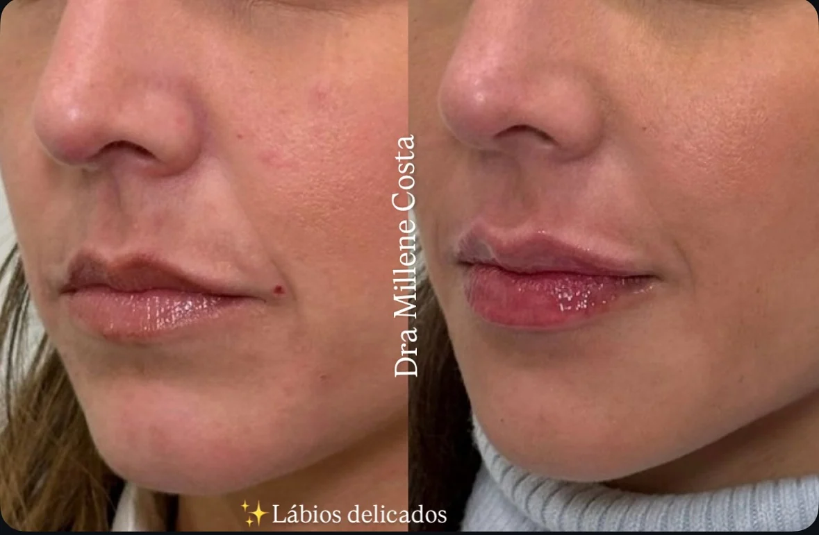 Antes e depois de preenchimento labial delicado