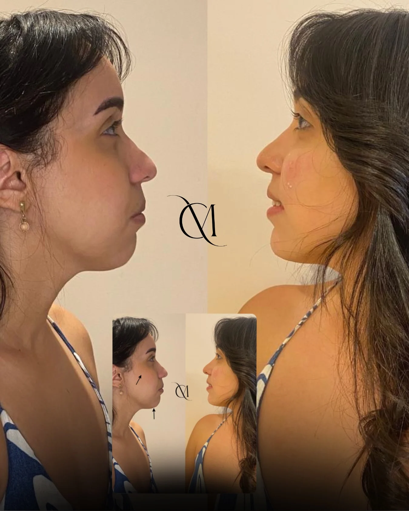 Antes e depois de perfiloplastia realizada pela Dra. Millene Costa