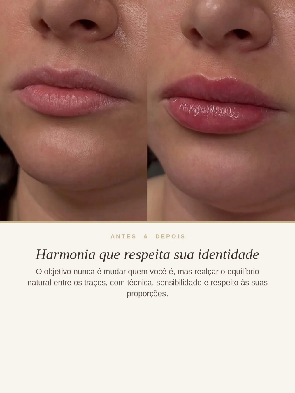 Antes e depois de preenchimento labial natural